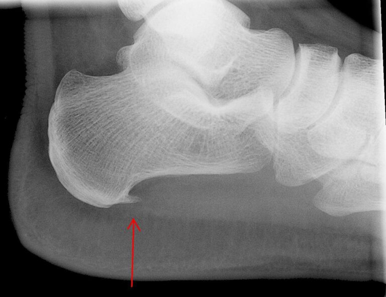 plantar fasciitis image